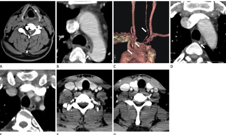 Fig. 1. A 34-year-old man with an incidentally diagnosed aberrant right vertebral artery