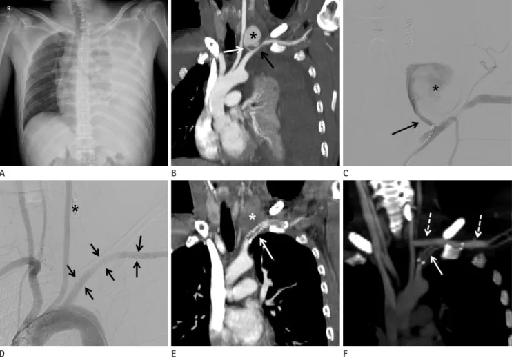 Fig. 1. A 34-year-old man with neurofibromatosis. 