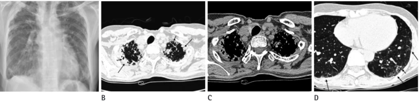 Fig. 2. Coronal reformation CT images shows progressive subpleural irregular opacities and traction bronchiectasis with volume loss in both up- up-per lungs, and less progressive subpleural reticular opacities with volume loss in both lower lungs than upup