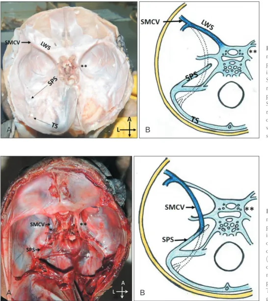 Fig. 1. Drainage pattern of superficial  middle cerebral vein (SMCV)­sphe no­