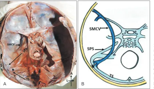 Fig. 3. Drainage pattern of superficial  middle cerebral vein (SMCV)­basal type. 