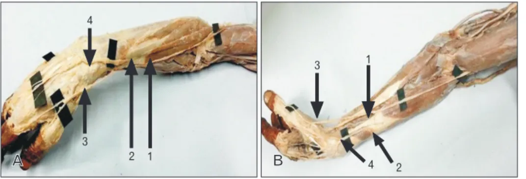 Fig. 2. Photographs of dorsal view of  the right hand (A) and the left hand (B)  showing cutaneous innervation