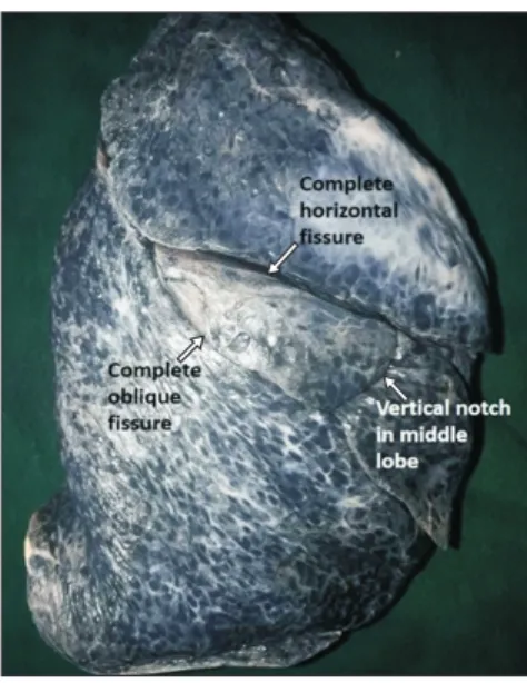 Fig. 1. Right lung showing complete oblique and complete horizontal  fissure along with a vertical notch in middle lobe.