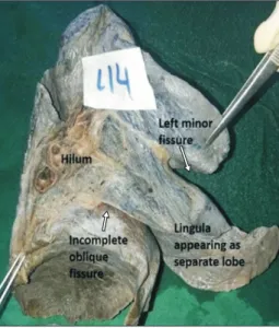 Fig. 8. Right lung showing complete oblique, complete horizontal and  inferior accessory fissure along with accessory lobe.