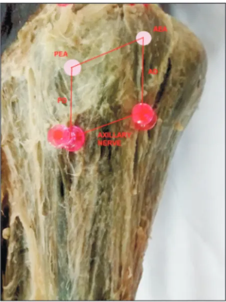 Fig. 2. The deltoid muscle was replaced in its original anatomical  position. The course of axillary nerve is shown with the help of needles,  and the anterior axillary distance (AD) and posterior  acromio-axillary distance (PD) were measured