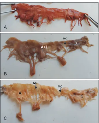 Fig. 2. Supraventricular leaflet (SVL) overlying the supraventricular  crest between the two major commissures (asterisks)