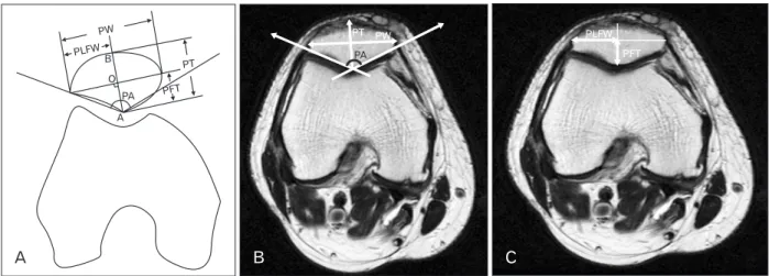 Fig. 1. The schematic representation (A) (A, point of the patellar central ridge; B, patellar anterior point; O, patellar central point) and the mag- mag-netic resonance imaging (MRI) right knee T2 axial section (B) illustrating the landmarks for measuring