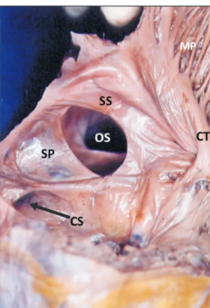 Fig. 1. Interior of the right atrium showing the large ostium secundum  defect. Crista terminalis (CT) and musculi pectinati (MP) can also be  seen.