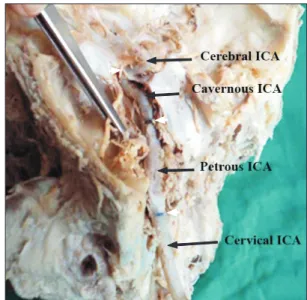 Fig. 1. In-situ exposed internal carotid artery. The petrous temporal  bone has been opened to expose the carotid canal and the petrous part  of the internal carotid artery (ICA)