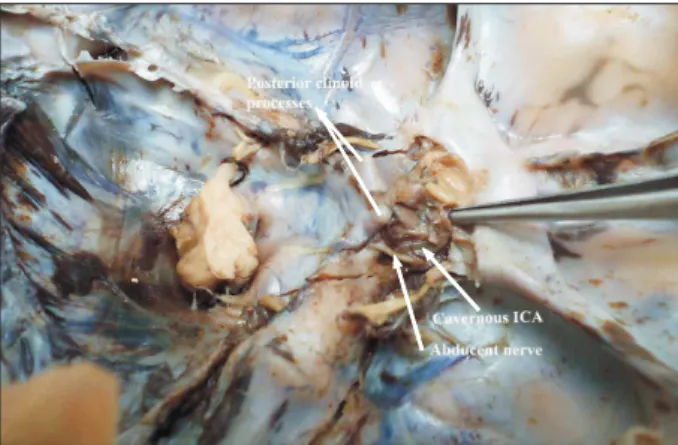 Fig. 2. Fetal internal carotid artery (ICA) exposed in the cavernous  sinus. Note the gentle curvature that the artery takes as it courses  through the sinus.