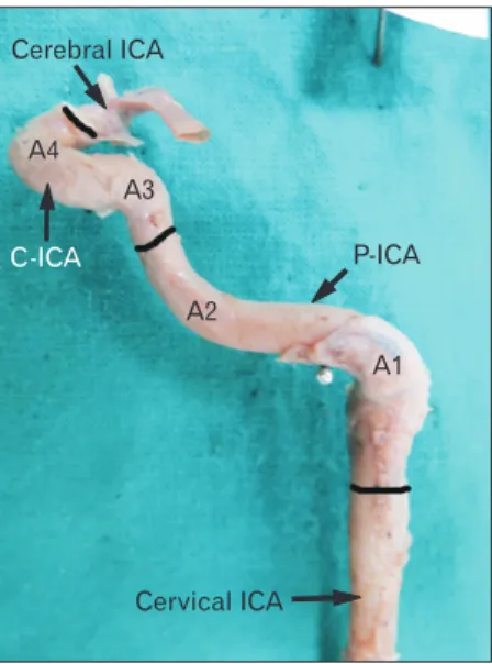 Fig. 5. Type 3 angulation in A3. Note a near right angle bend at A3. 