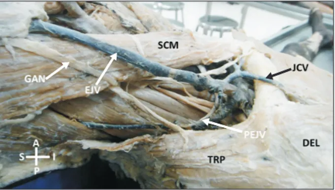 Fig. 2. Dissection of the upper part of the right arm and right side  of the neck showing JCV
