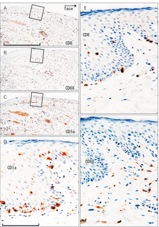 Fig. 2. CD1a-positive Langerhans  cells, CD8-positive T lymphocytes and  CD68-positive macrophages in the  lower lip