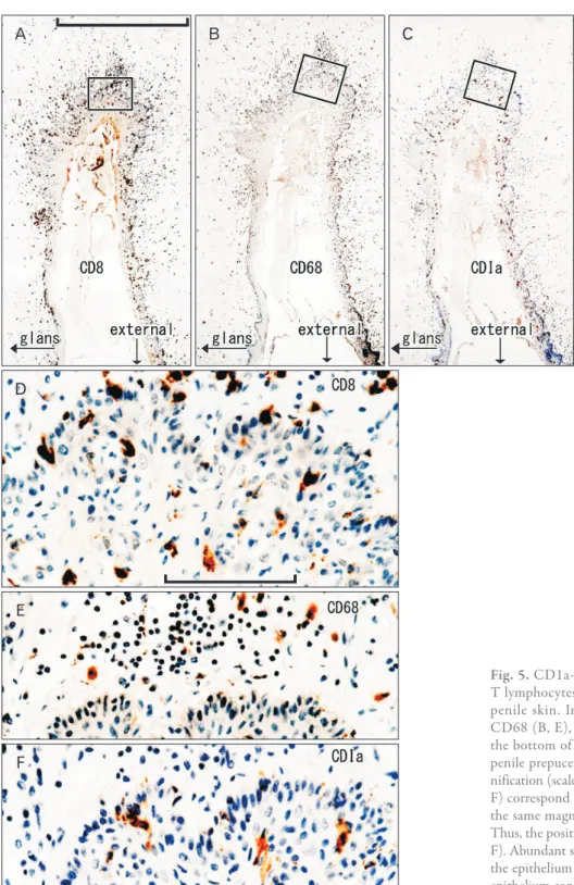 Fig. 5. CD1a-positive Langerhans cells, CD8-positive  T lymphocytes and CD68-positive macrophages in the  penile skin