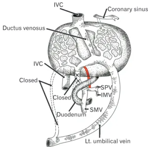 Fig. 3. Understanding of the present anomaly as a left vitelline vein. 