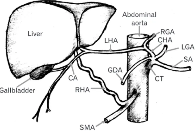 Fig. 2. Schematic representation of Fig. 1 showing multiple variations in  arterial anatomy as observed in present case
