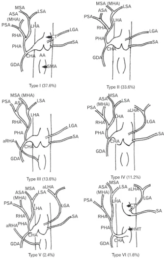 Fig. 1. Illustrative representation of the types of hepatic arterial  configuration observed in the study based on the varia tions in the  origin of middle hepatic artery (MHA), taking into consideration the  presence of accessory hepatic arteries