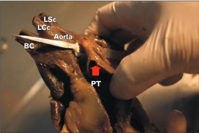 Fig. 6.  Persistent ductus arteriosus. Pulmonary trunk (PT) connects  to aorta by persistent ductus arteriosus (arrow)