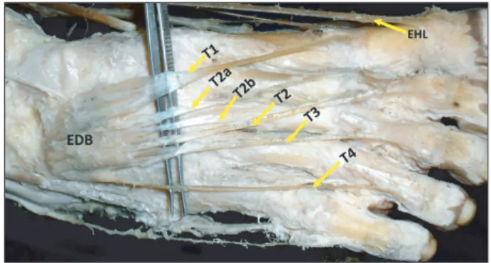 Fig. 5. Dissection of the dorsum of the right foot showing the proximal  and distal attachments of the extensor digitorum brevis (EDB) muscle