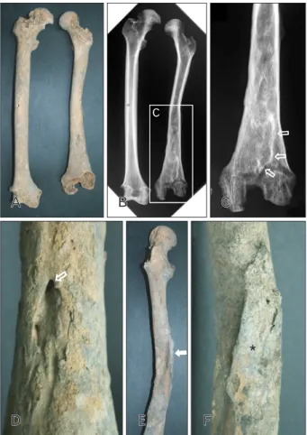 Fig. 1. Left femur shaft fracture from tomb of case no. 33. (A)  Marked deformity consisting of axial deviation and some rotation,  resulting in shortening as compared with counterpart right femur