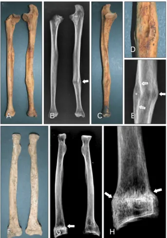 Fig. 3. (A) Fractures of the left tibia and fibula from tomb of case no. 