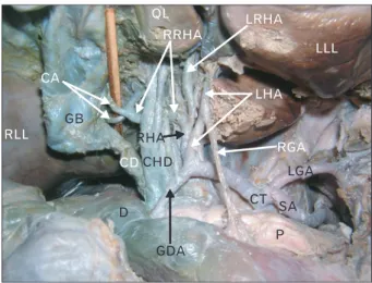 Fig. 1. Dissection of the celiac trunk and its branches. CA, cystic  arteries; CD, cystic duct; CHD, common hepatic duct; CT, celiac  trunk; D, duodenum; GB, gall bladder; GDA, gastroduodenal artery; 
