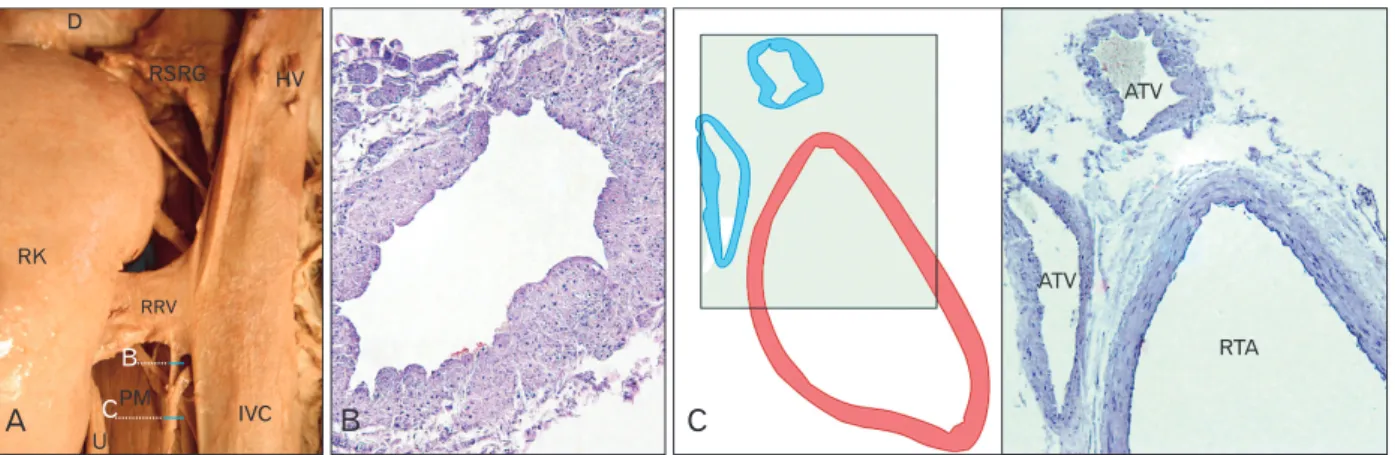 Fig. 2. Right retroperitoneal space dissection shows; (A) the abnormal drainage of additional testicular vein into the right renal vein