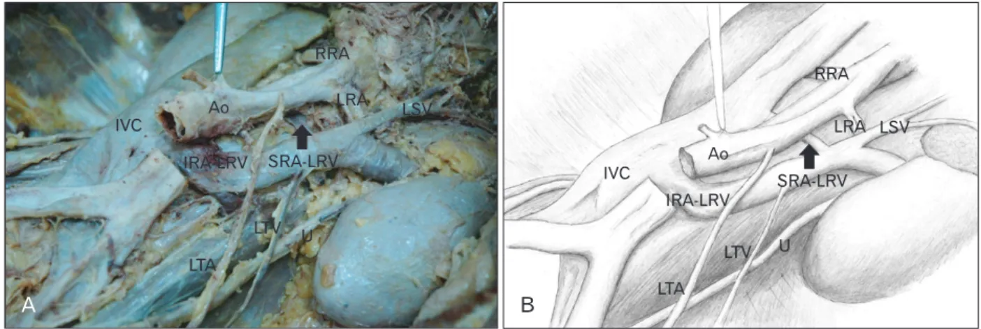 Table 1. Frequency of retro-aortic renal vein anomalies according to various  authors