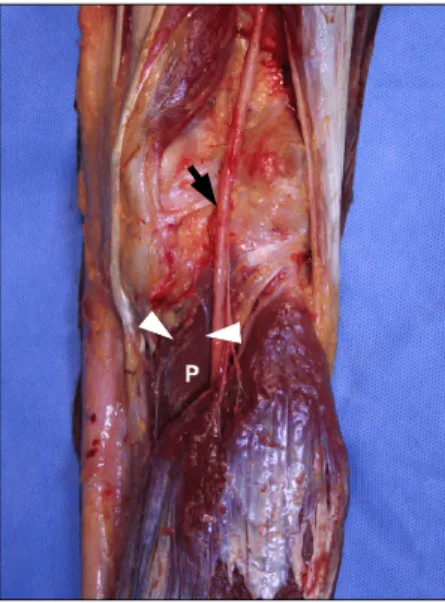 Fig. 3. Triangular popliteus: superior, medial, and inferior angles were  27.2±4.3 o , 114.8±19.8 o , and 38.0±18.8 o  respectively; superior, medial,  and lateral sides of the triangle were 7.6±1.0 cm, 6.2±1.0 cm, and 11.9 