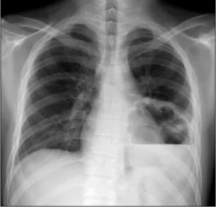 Fig. 1. Chest plain radiograph showing lung abscess.