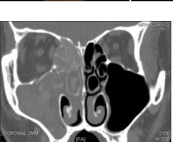 Fig. 1. Endoscopic finding of right  nasal cavity shows polypoid mucosa  and nasal septum deviation.