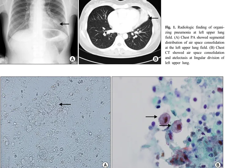 Fig. 1. Radiologic finding of organi- organi-zing pneumonia at left upper lung  field