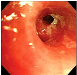 Fig. 3. Flexible bronchoscopy showed severe mucosal inflammation with purulent secretion in the lingular segment of left upper lobe  bronchus