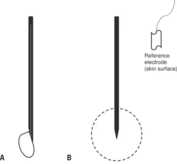 fig. 1. Types and recording area of electromyography needles. (A) A  concentric needle and its recording field (side view)