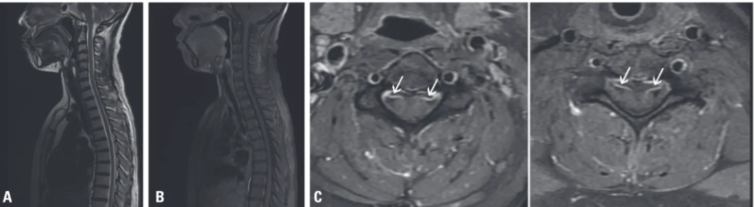 Fig. 1. Cervical and thoracic spinal MRI. A T2 sagittal image (A) and T1 gadolinium-enhanced sagittal image (B) show unremarkable findings