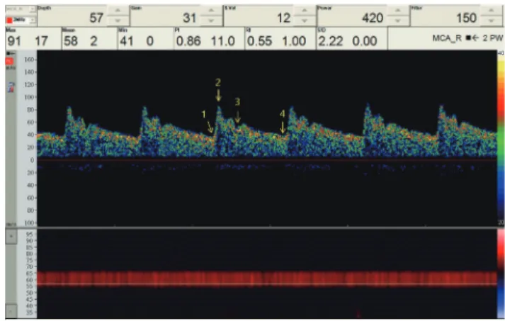 fig. 3. Normal transcranial Doppler spectral waveform of the middle  cerebral artery. The interval from phase 1 to phase 2 is referred to as  sys-tolic acceleration, and reflects the resistance from the heart to the artery  of interest