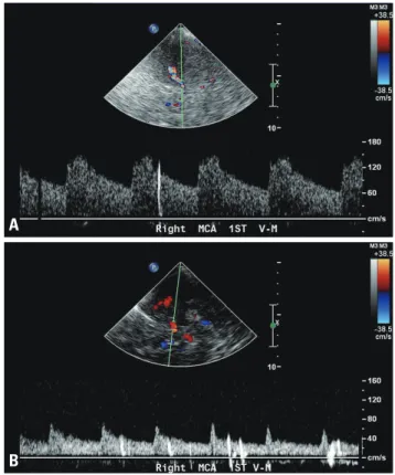 fig. 4. Thrombolysis in Brain Ischemia grading system.