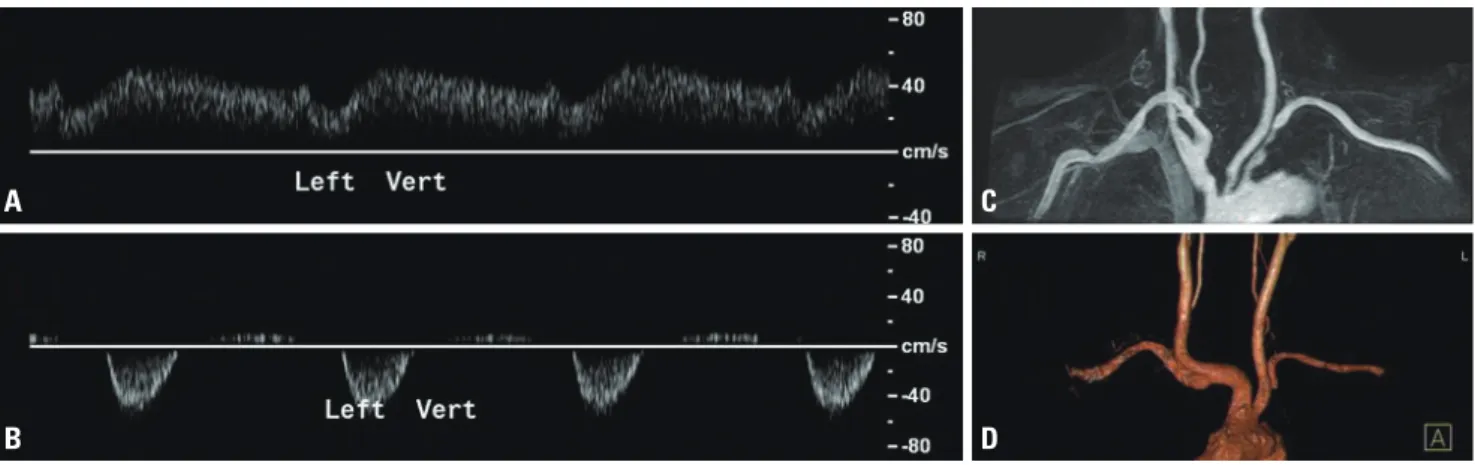 fig. 6. The subclavian steal phenomenon. Bunny (A) and reversed (B) waveforms can be used to predict the presence of moderate stenosis (C) and  occlusion (D) of the ipsilateral subclavian arteries, respectively.