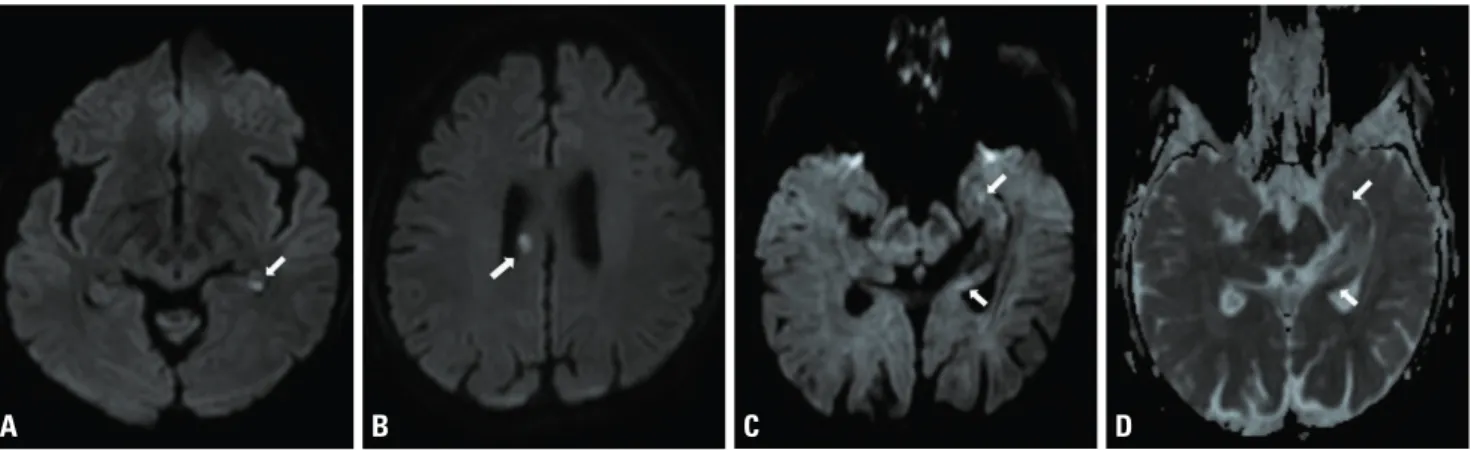 Fig. 1. Hyperintensities on a magnetic resonance imaging scan in a patient with recurrent transient global amnesia (TGA) episodes