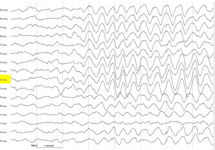 Fig. 1. Electroencephalography (average montage) showed diffuse background slowing associated with prolonged bursts of high voltage rhythmic 1.5  to 2.5 per second “notched delta”, occurring in all leads bilaterally and synchronously.