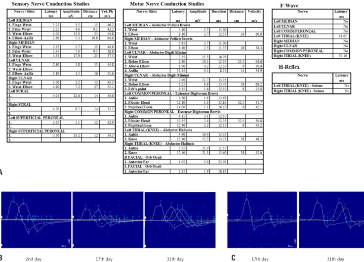 Fig. 1. Nerve conduction studies in the present case. (A) Initial nerve conduction study which was performed on the second day of admission exhibit- exhibit-ed the decreasexhibit-ed sensory nerve action potential amplitude and compound motor action potenti