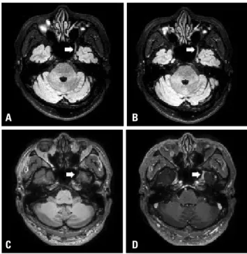 Fig. 1. Magnetic resonance imaging of the cranial nerve. Diffuse swell- swell-ing and thickenswell-ing of the maxillary branch of the left trigeminal nerve  was noted in a nonenhanced fluid-attenuated inversion recovery with  fat saturation axial image (A)