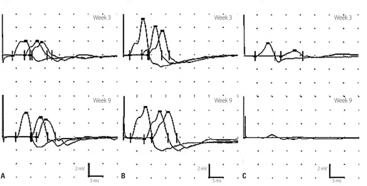 Fig. 1. Data from nerve conduction studies. Motor nerve conduction studies revealed normal velocities but variable decreases in amplitude in the  median (A), ulnar (B), and tibial (C) nerves