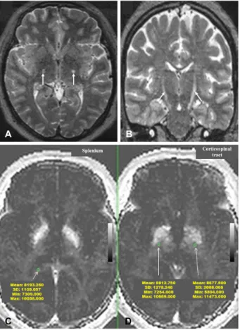 Figure 1. (A, B) Axial (A) and coronal (B) T2-weighted MRI  of the brain display bilateral high signal intensity along the  corticospinal tract (CST) (white arrows)