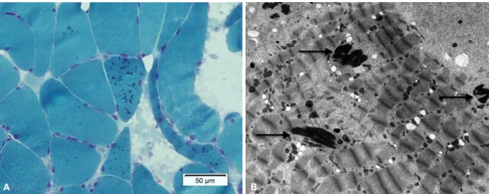 Figure 2. Pathologic finding of the patient. Nemaline rods are shown on a modified Gomori-trichrome stain (×200) (A)
