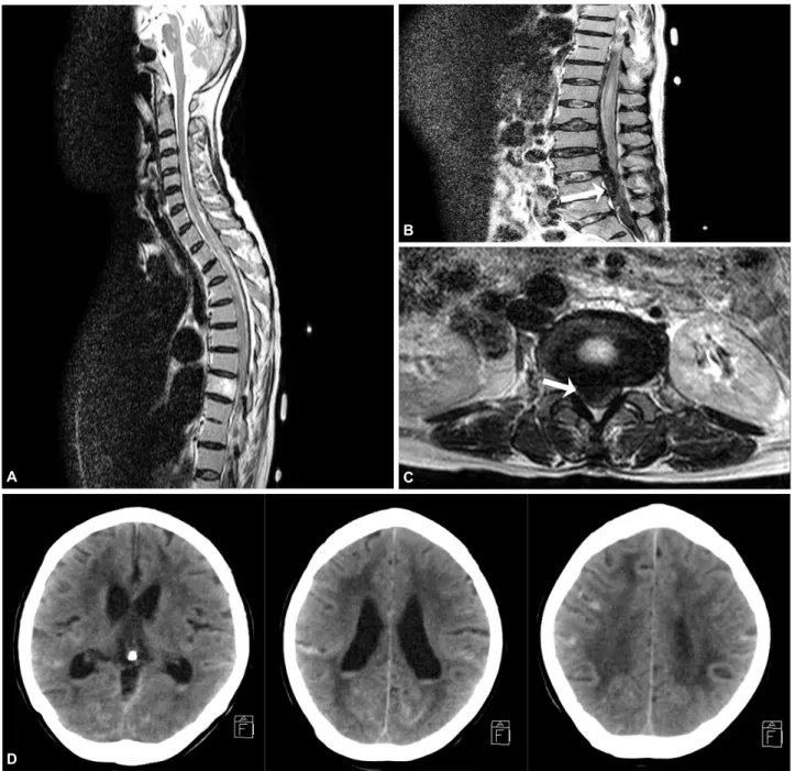 Figure 1. Spine MRI and brain CT of patient. Spine MRI shows diffuse low signal intensity in the posterior part of spinal  canal region on T2 weighted image (A)