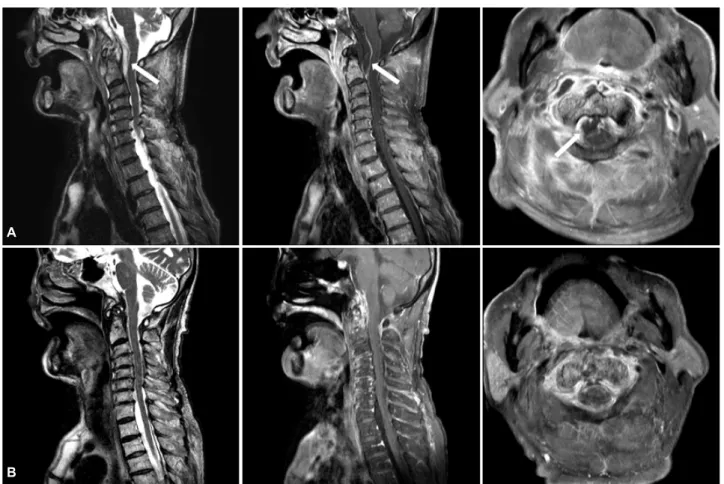 Figure 1. Initial cervical spine MRI shows enhancing epidural fluid collection (white arrow) at atlantoaxial joint and C1-2  level