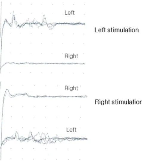 Figure 1. Blink reflex tests and photographs. (A) Bilateral external ophthalmo- ophthalmo-plegia and ptosis