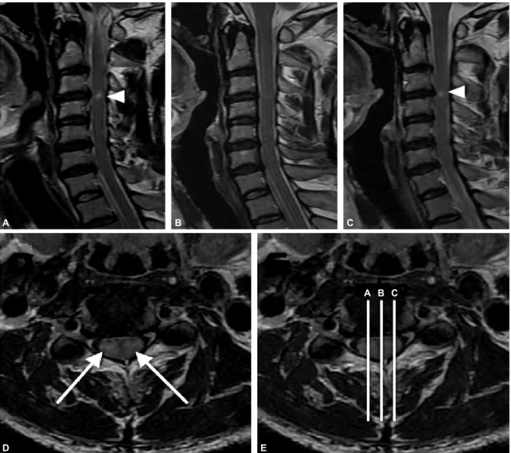 Figure 2. Follow up cervical cord MRI 17 days after the onset shows increased signal intensities in T2-weighted images (A and C, arrow heads) as “eyes of owl” pattern (D, arrows)