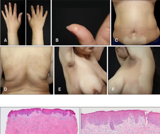 Fig. 3. Finger specimen. (A) A ‘squ- ‘squ-are appearance’ in a punch biopsy  (hematoxylin and eosin [H&amp;E], ×40).